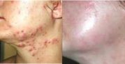 Rejuvi acne